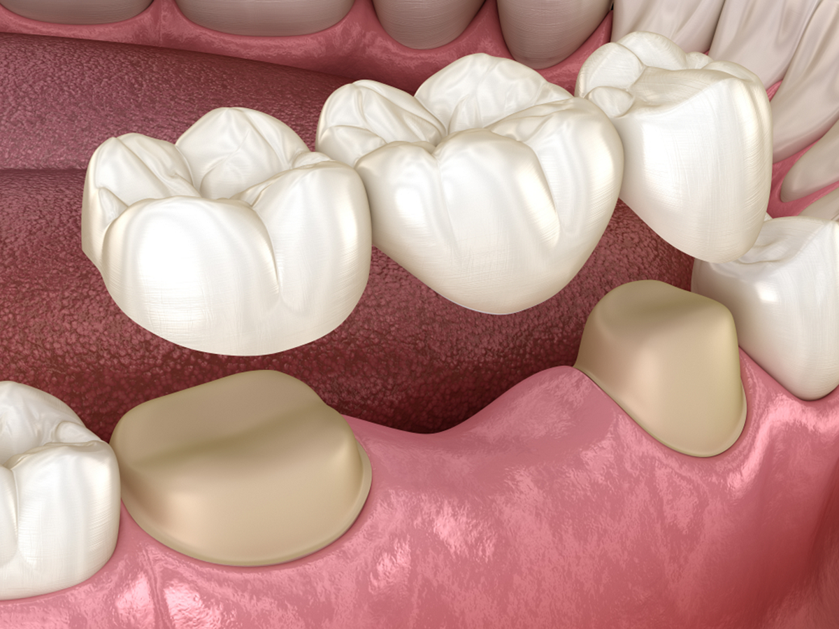 can a dental bridge be taken out and replaced
