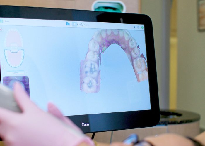 Invisalign Dentists Cooper City Fl Invisalign Dentists Cooper City Fl